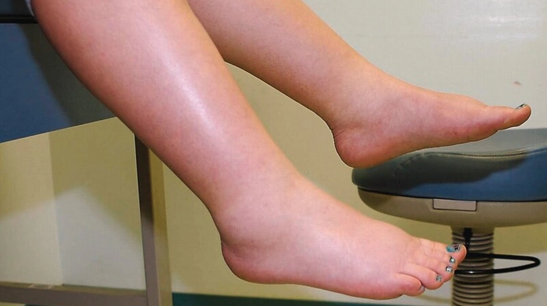 Phù Thũng Là Gì? Nguyên Nhân, Biểu Hiện và Cách Điều Trị Hiệu Quả